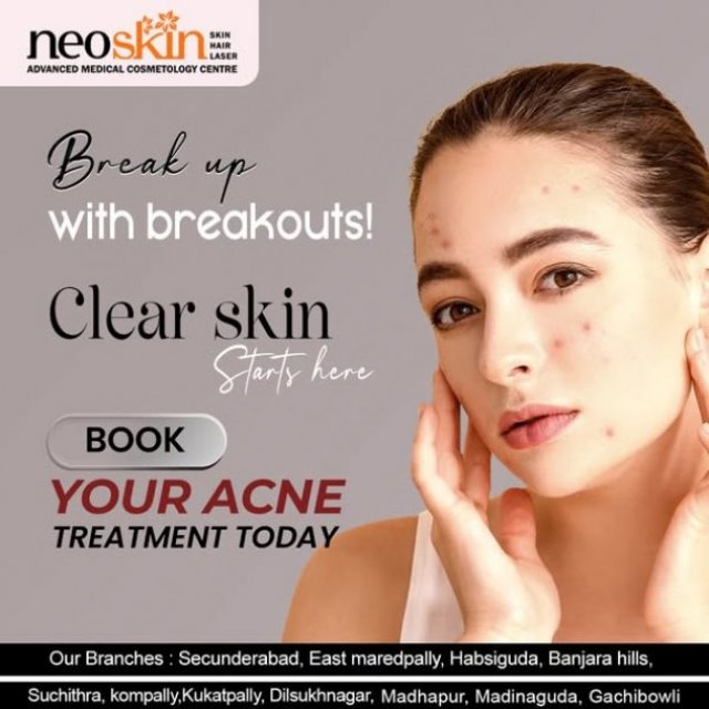 Acne scar Treatment in Hyderabad | Neoskin Clinic