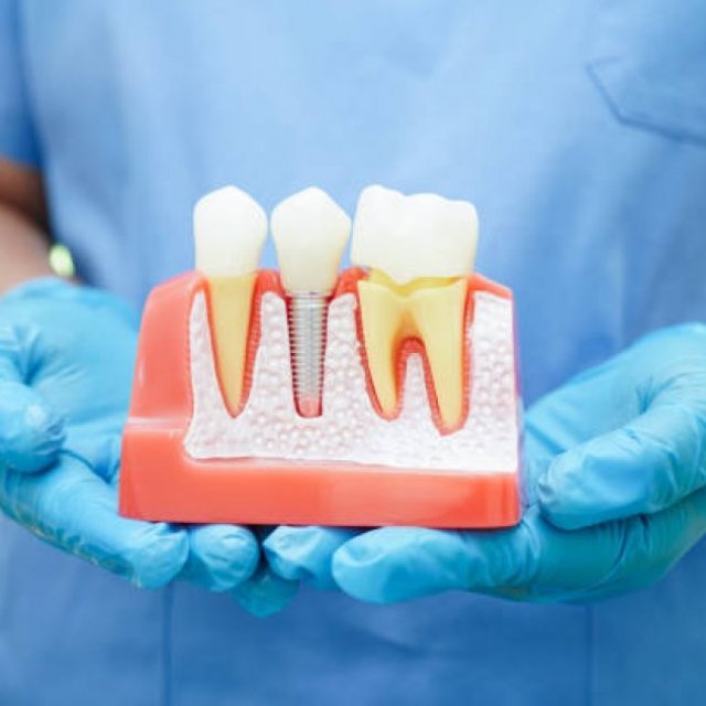 Are Dental Implants Covered by Insurance?