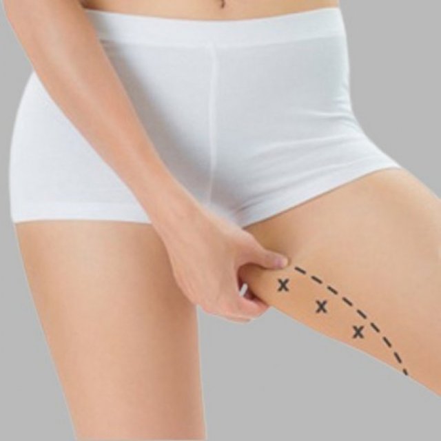 What to Expect During Your Initial Thigh Lift Consultation