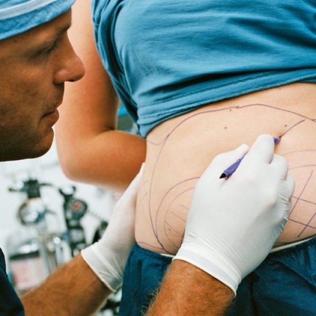 Liposuction in Riyadh