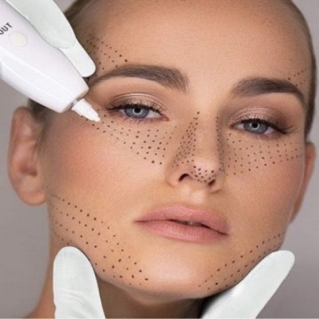 Plexr and Acne Scars Around the Eye Area