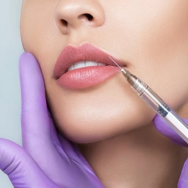 Lip Exercises: Are They Worth It After Fillers?
