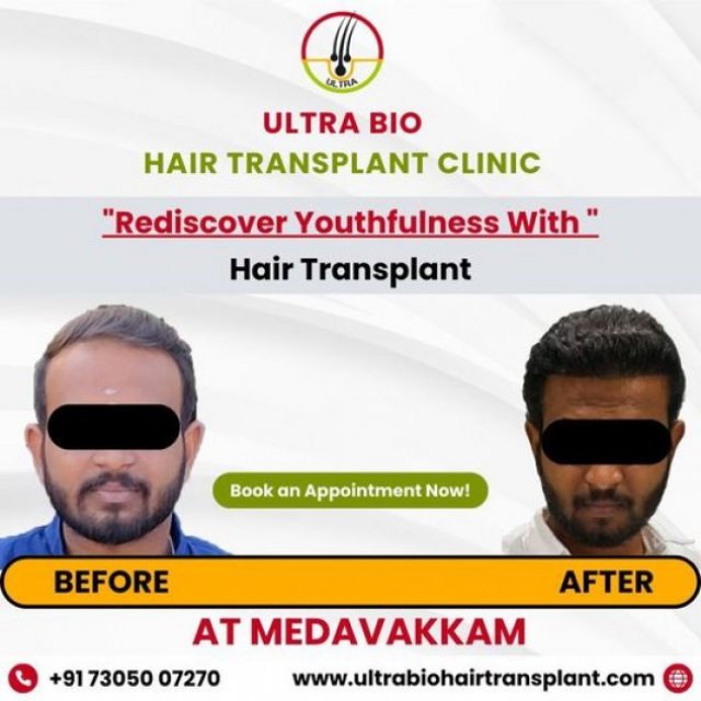 ULTRA BIO HAIR TRANSPLANT CLINIC