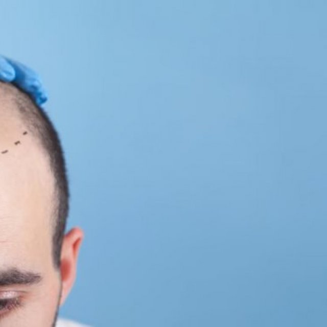 Ayushman Hair Transplant Centre