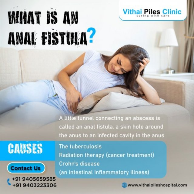 Fistula Treatment Specialist in Pune