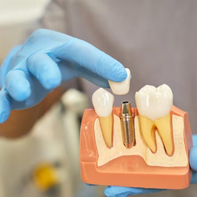 Are Dental Implants Safe or Not ?