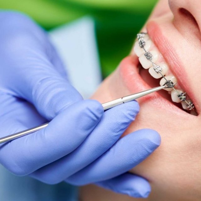 What is Orthodontic Tooth Uncovering ?