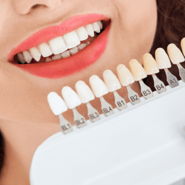 E-max Veneers in Dubai