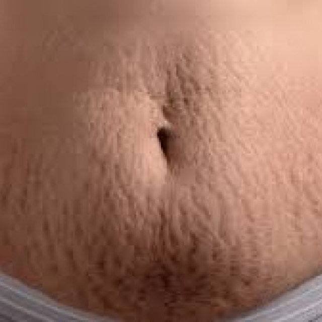 Stretch Marks Removal in Dubai & Abu Dhabi