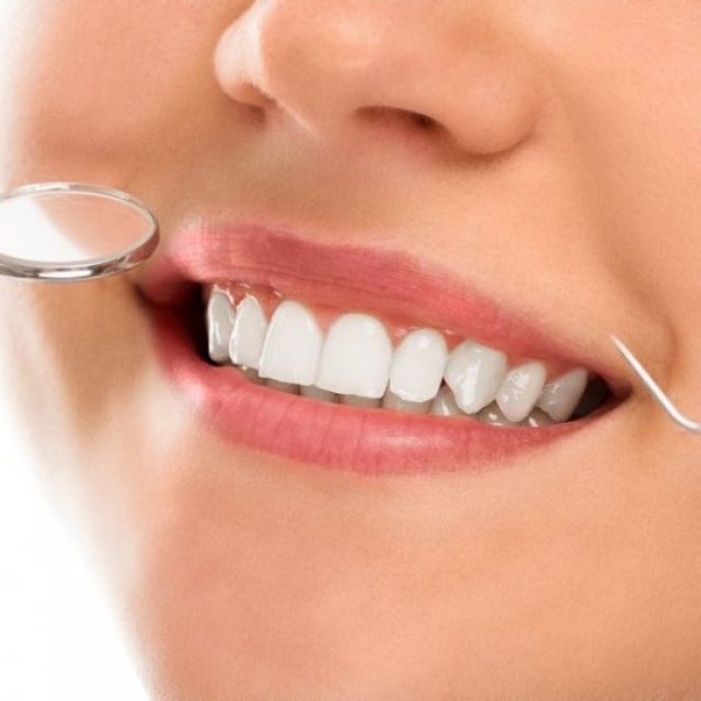 Composite Veneers in Dubai